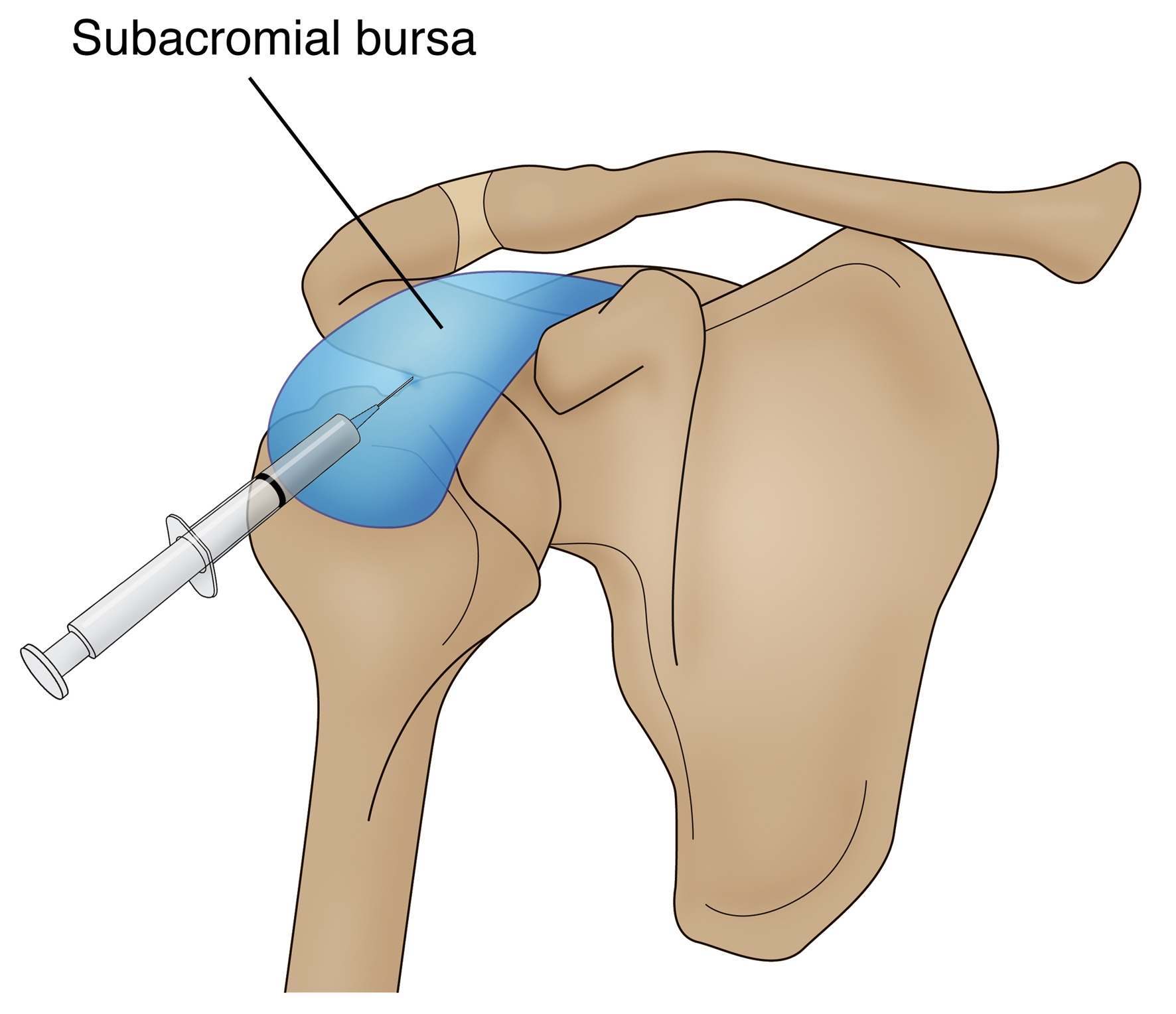 Figure 3: Injection piercing the subacromial bursa within the subacromial space