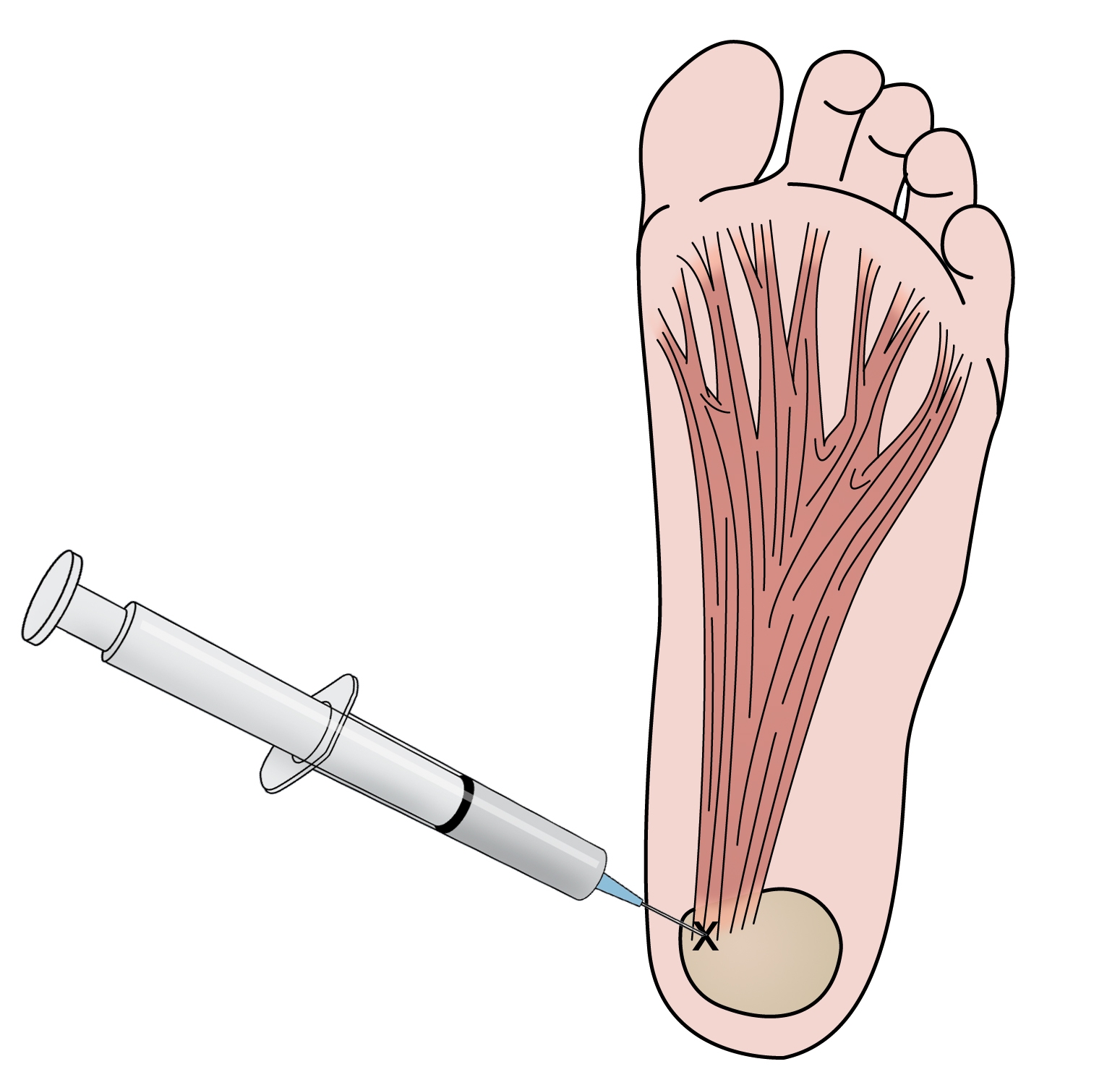 Figure 4: Plantar fasciitis injection