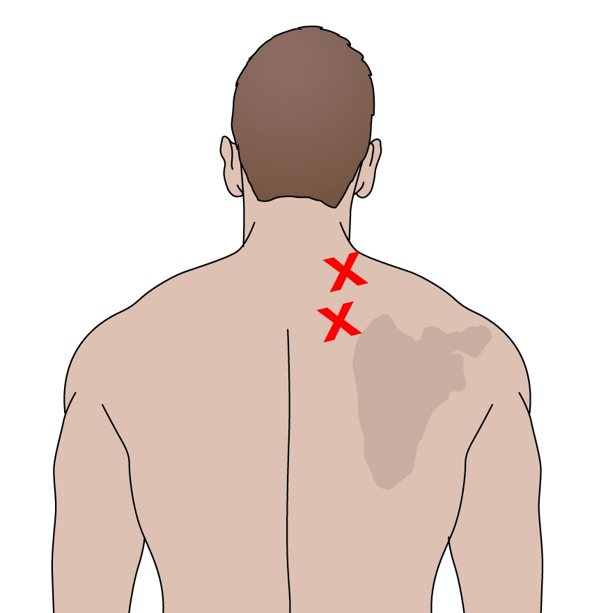 Figure 3: Myofascial trigger point location and referral pattern
