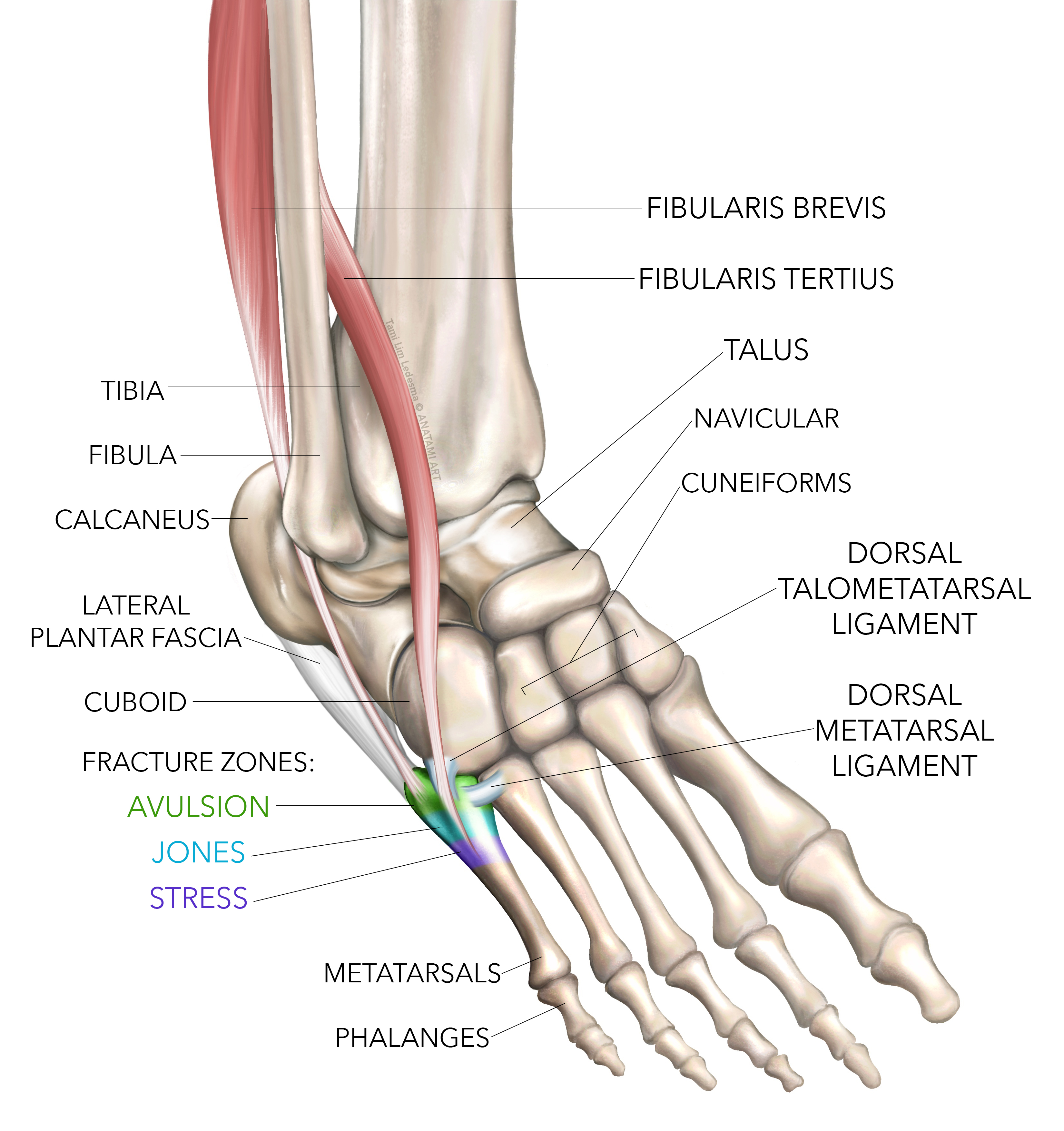 Sports Injury Bulletin - - Fractures of the Proximal 5th Metatarsal in Athletes