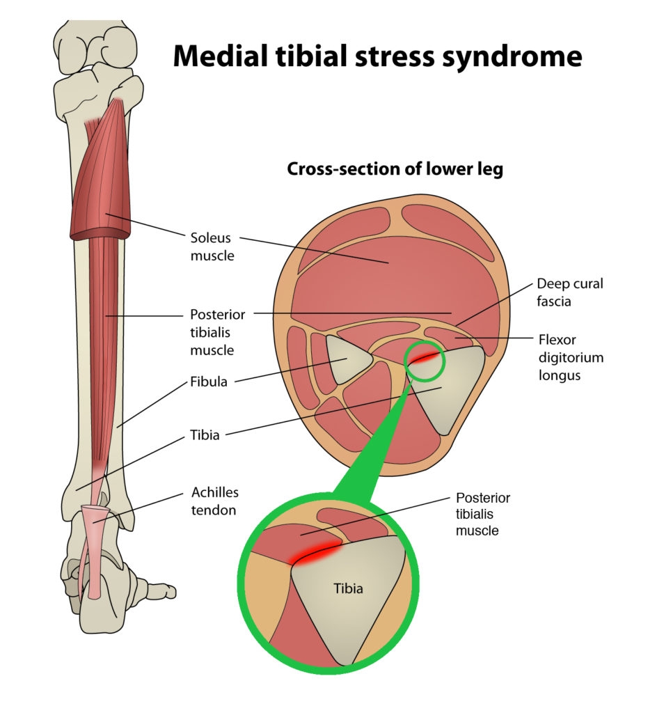 Figure 1: Anatomy of the lower leg and MTSS