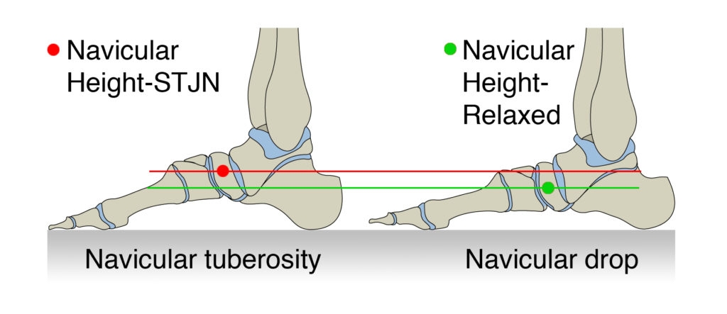 Figure 2: Navicular drop