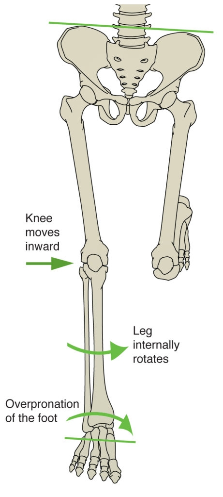 The relationship of hip, knee, ankle and foot movement in the kinetic chain during the stance phase of running if there is significant weakness or fatigue in the hip muscles.