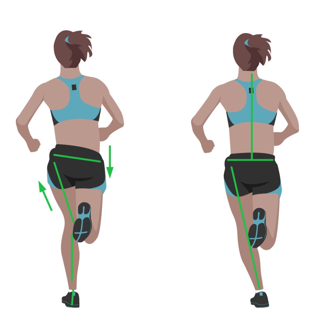 Videotaping your runner while on a treadmill enables you to analyse their gait, frame by frame. Typically, if the runner is overpronating and there is a weakness at the hip joint, at mid stance you will see knee adduction, foot pronation, abduction of the forefoot and a drop of the opposite hip of more than four to five degrees. Some runners may have significant pronation but run with hips level (within five degrees) and minimal knee adduction. In this case, weak tibialis posterior, a tight calf muscle, lax ligaments, or structural deviations may cause the pronation, but the hip tests strong and functions well while running.