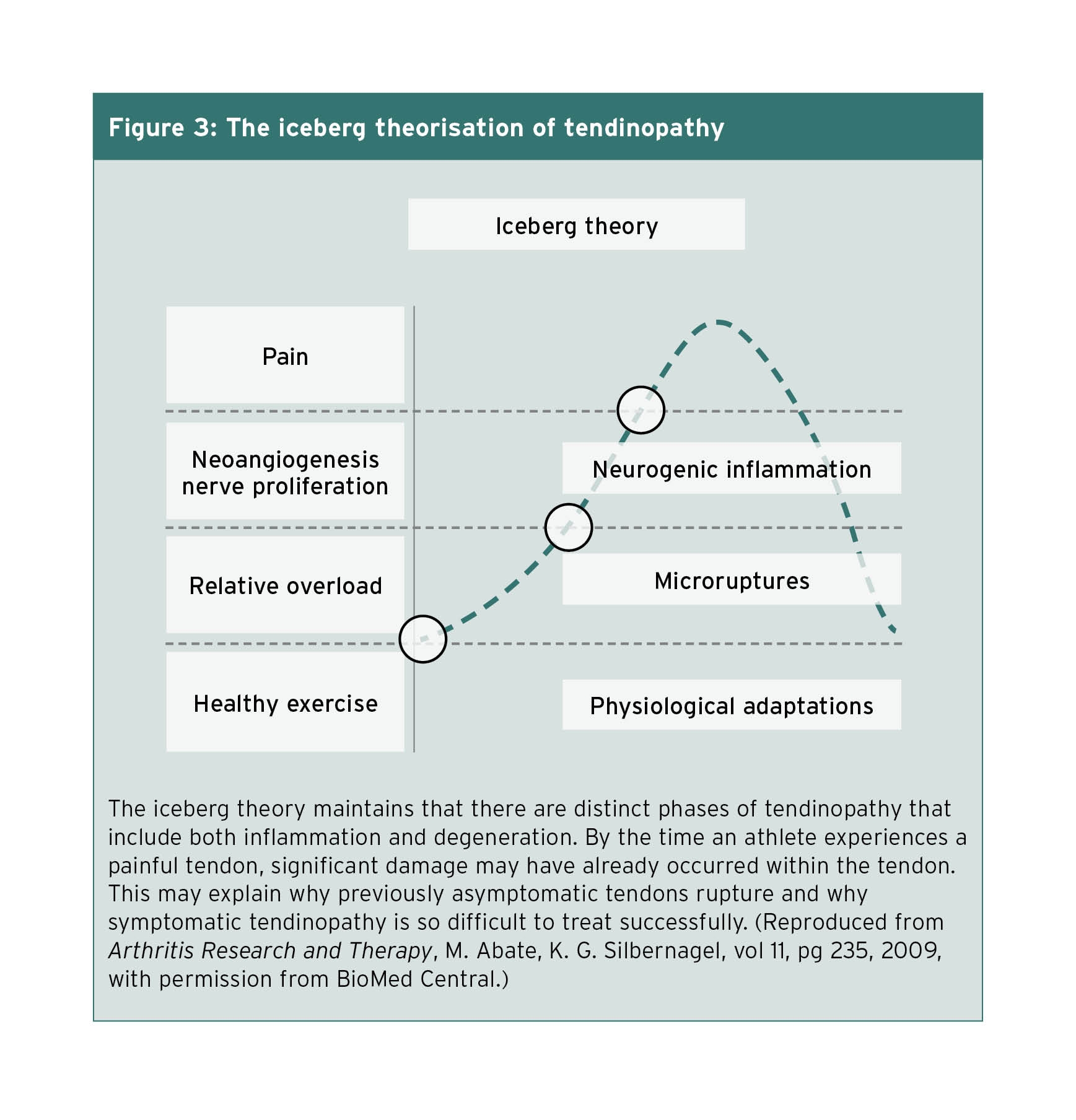 The iceberg theory maintains that there are distinct phases of tendinopathy that include both inflammation and degeneration. By the time an athlete experiences a painful tendon, significant damage may have already occurred within the tendon. This may explain why previously asymptomatic tendons rupture and why symptomatic tendinopathy is so difficult to treat successfully. (Reproduced from Arthritis Research and Therapy, M. Abate, K. G. Silbernagel, vol 11, pg 235, 2009, with permission from BioMed Central.)