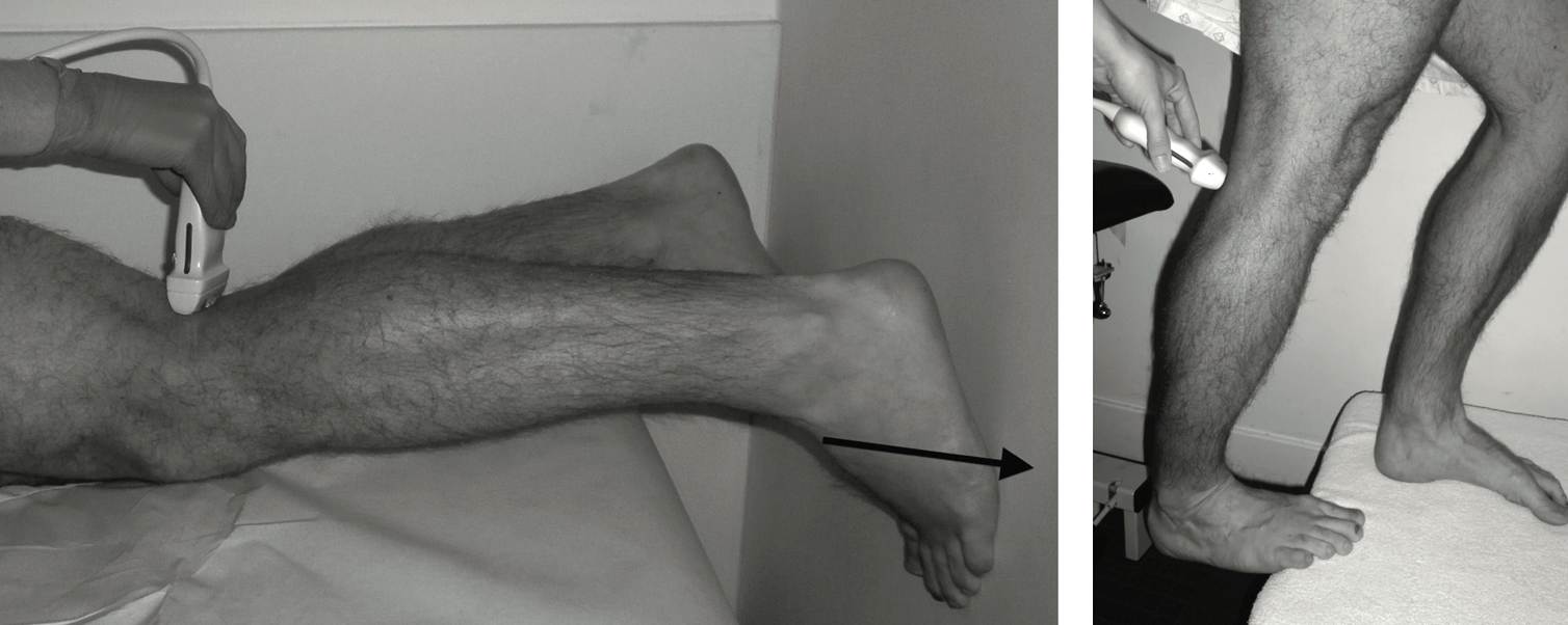 Evaluation is carried out during partially resisted plantar flexion in prone, and during the heel drop test. (Used with permission J Sports Med. 2014; 2014: 105953)