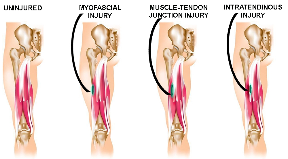 Sports Injury Bulletin - Anatomy - Hamstring injuries: why location and  anatomy matters!