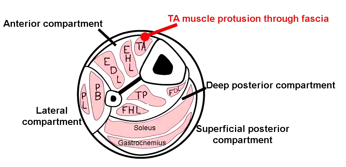 Muscle hernia in a 40-year-old man with a tender palpable mass at