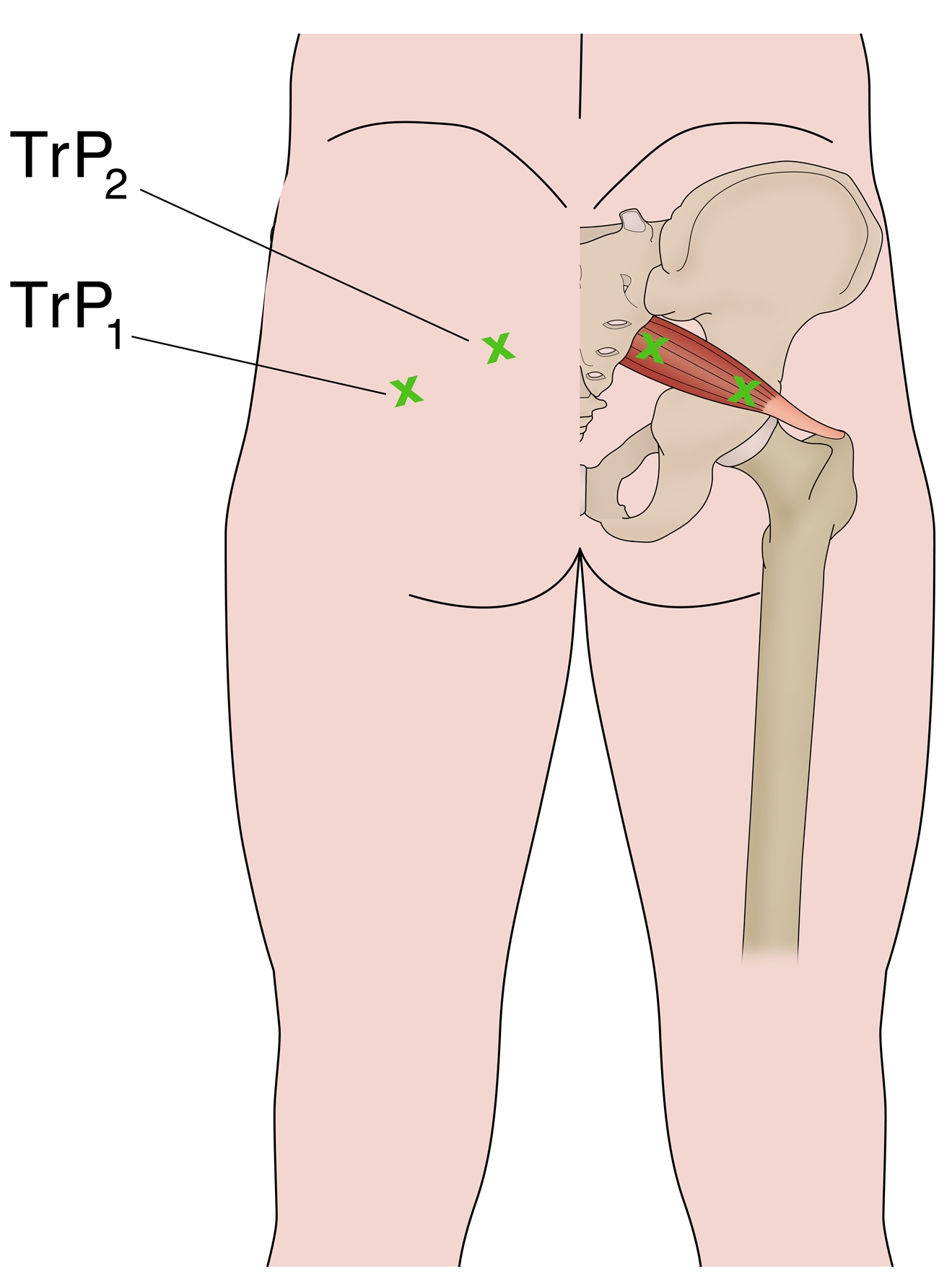 Figure 4: Myofascial trigger point location