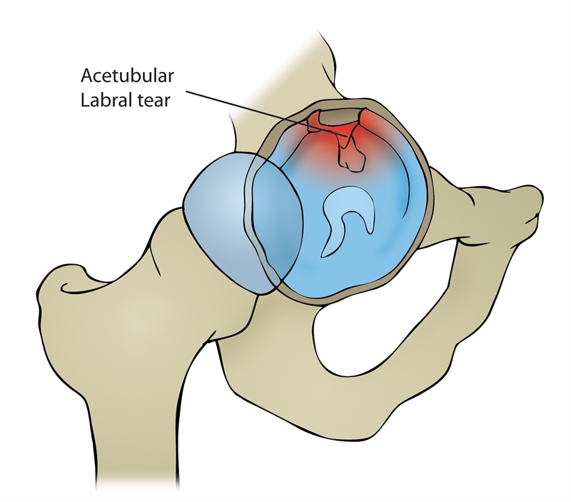 Figure 1: illustration of an acetabular labral tear at the anterior surface