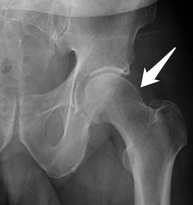 Figure 5: AP xray showing a prominent femoral neck