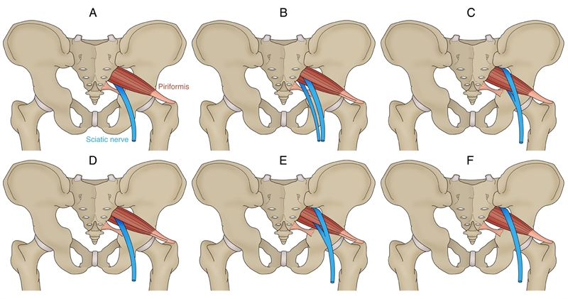 Figure 3: Variations of the piriformis to sciatic nerve relationship