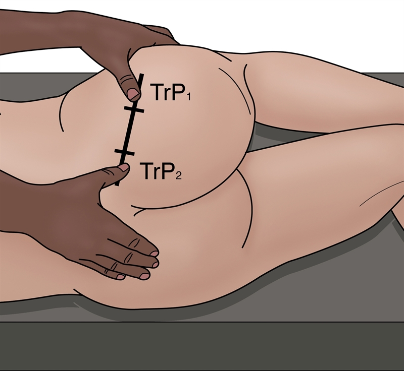 Figure 8: Suggested location of PM trigger points