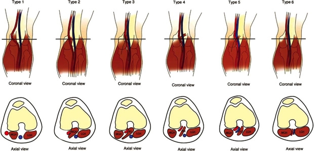 The six different types of anatomical PAES as determined by the Popliteal Vascular Entrapment Forum in 1998. The relationship of the popliteal artery to the surrounding musculature causes compression in certain positions or when the muscles are activated. Key: MGH – medial head of gastrocnemius LGH – lateral head of gastrocnemius AS – accessory slip of muscle PM – popliteus muscle