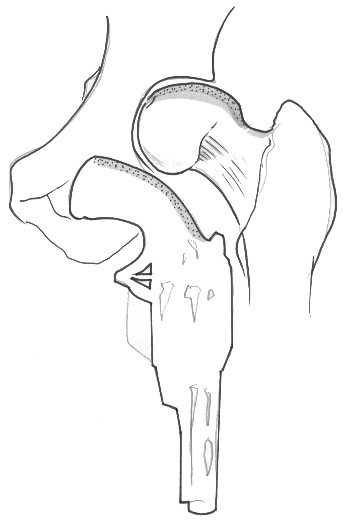 Pistol grip deformity of the femoral neck