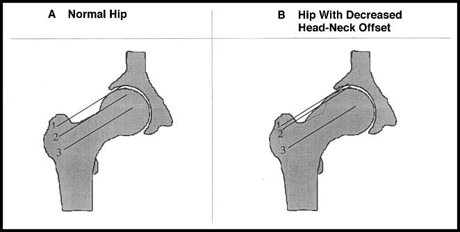 Reduced femoral neck offset in antero-lateral aspect of head neck junction