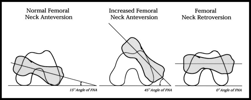Reduced femoral anteversion