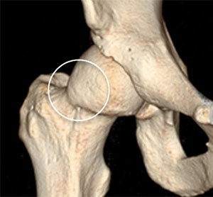 Figure 7: A 3-dimensional reconstruction of Cam lesion