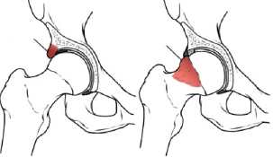 Figure 2: Cam and pincer lesions