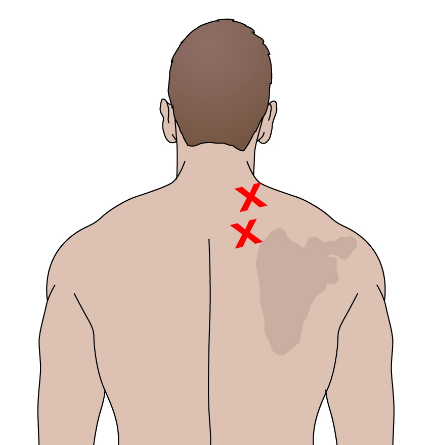 Neck Pain and Levator Scapulae Syndrome