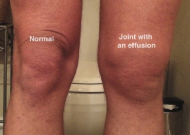 Figure 1: Knee joint effusion
