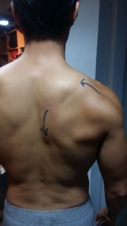 Figure 4b: Client demonstrating active upward rotation and retraction using lower trapezius