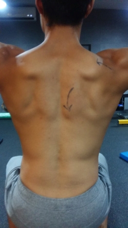 Figure 6b: Scapular setting. Finish position (the lower trapezius can be seen to contract under the downward arrow)